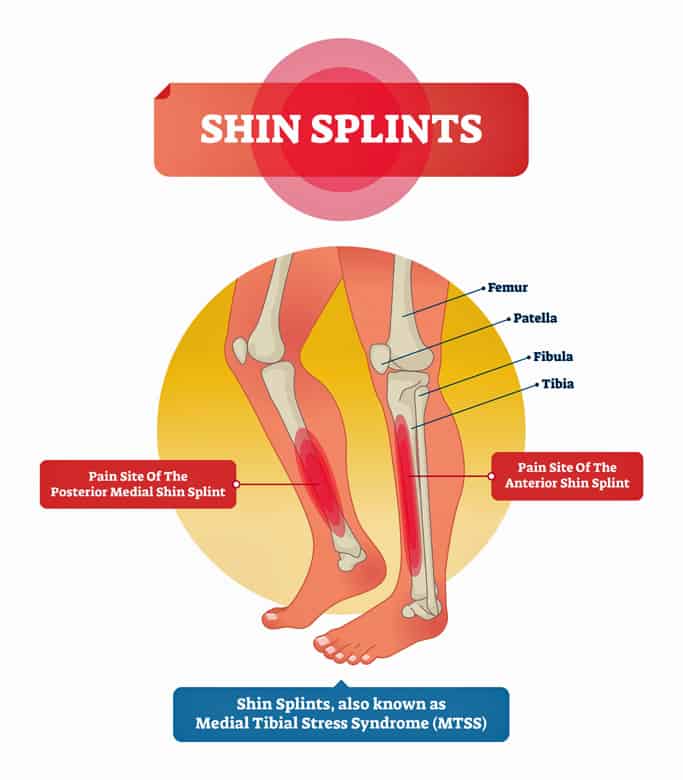 Diagram of where shun splints occur in the lower legs